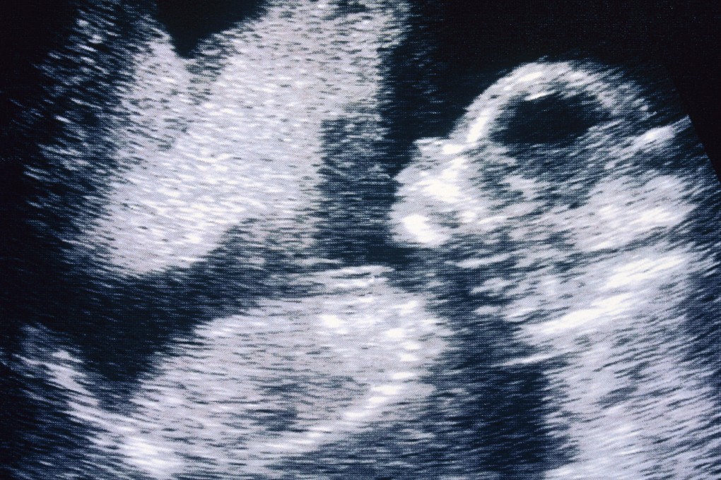 Small size in early pregnancy linked to poor heart health