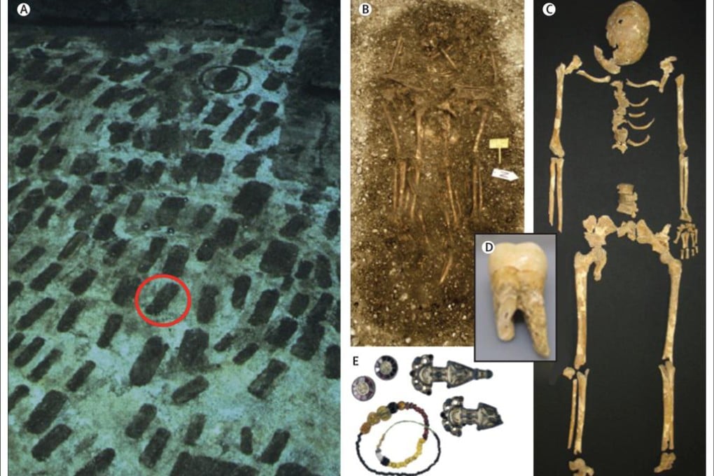 Photo composite showing A. grave in Bavaria, Germany of victim examined in study, B. Grave shared by victim and two other individuals, C. Victim's skeleton, D. Samples of tooth of victim, E. Items obtained from victim's grave used to estimate date of burial to 525–550 AD. Photo: SCMP