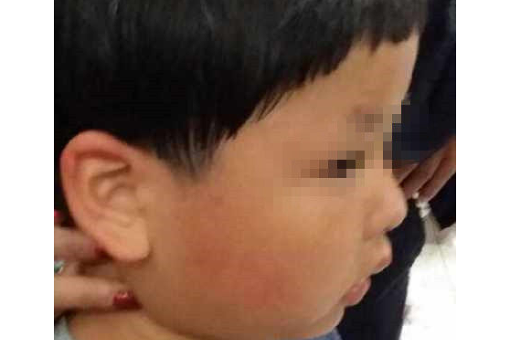 A photo from Sina Weibo purportedly shows a reddish mark where the boy had been slapped. Photo: SCMP