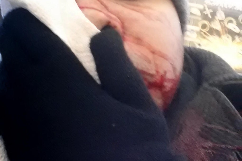 Barry Negron holds his face after being struck by ice from a building in New York. He required 80 stitches after the accident.Photo: AP