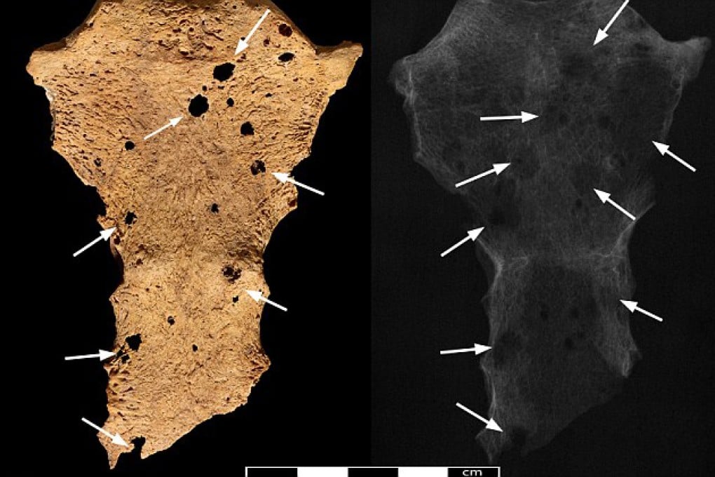 The sternum of the skeleton, believed to have belonged to a man aged between 25 and 35, pictured, shows evidence of cancer, highlighted by the arrows. Photo: British Museum