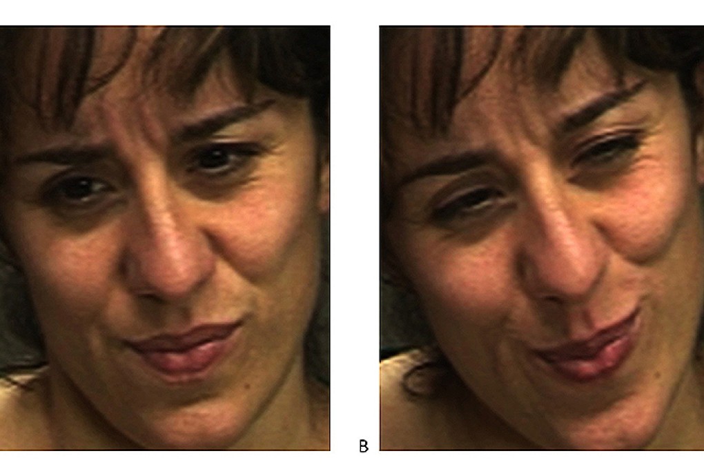 A woman's facial expression of pain, one real and one fake, is pictured in two different images. The real expression of pain is image B on the right. Photo: Reuters