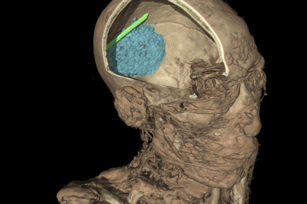 A tool was found inside this mummy's skull. Photo: AP