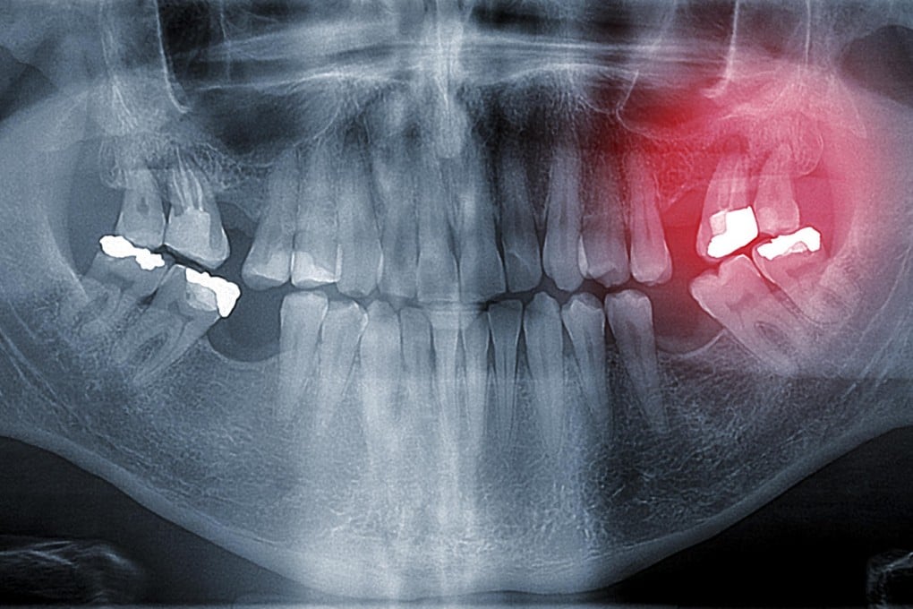 Amalgam fillings contain mercury, a toxic substance. But the amount used may be safe.