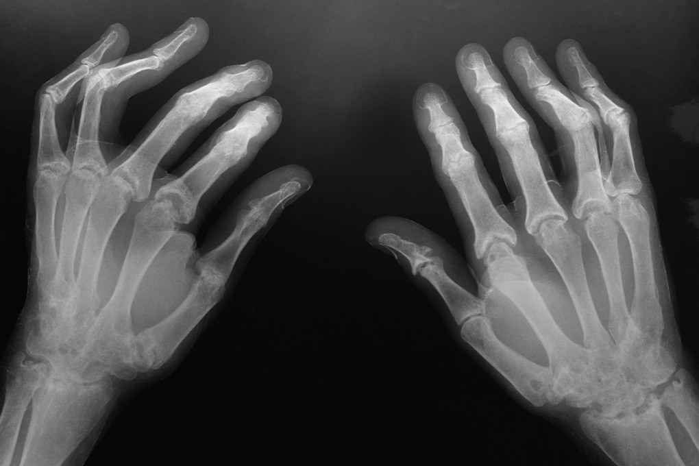 Getting a grip on arthritis