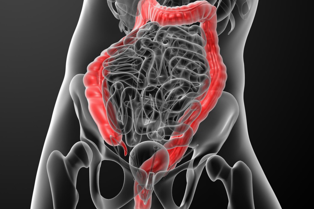 IBS remedies can only relieve symptoms.