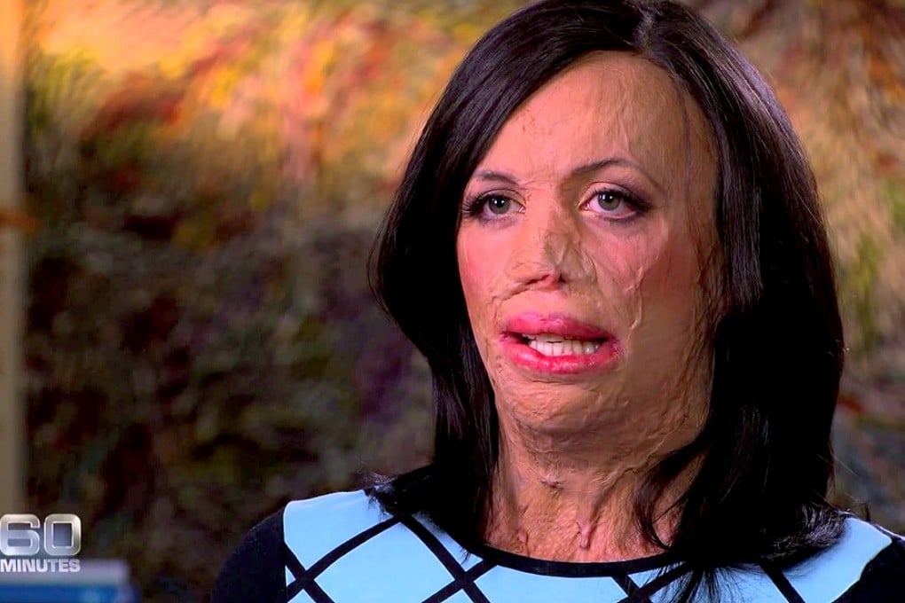 Former model Turia Pitt has spent about A$3 million on surgery since the horrific fire during an endurance race in the Kimberly region of Australia.