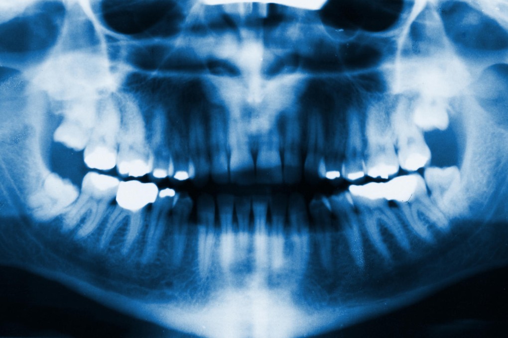 It takes 12 weeks for a tooth to grow a new layer of dentin, its core material