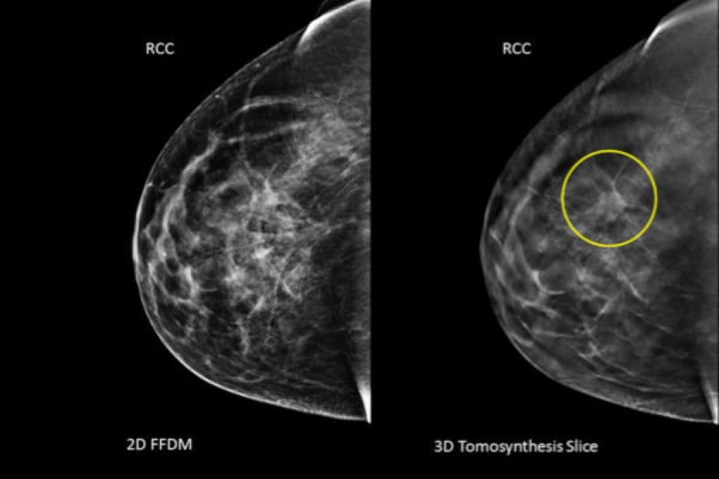 A conventional mammography (left) and one using 3D, with a tumour circled that wasn't visible on the first image. Photo: AP