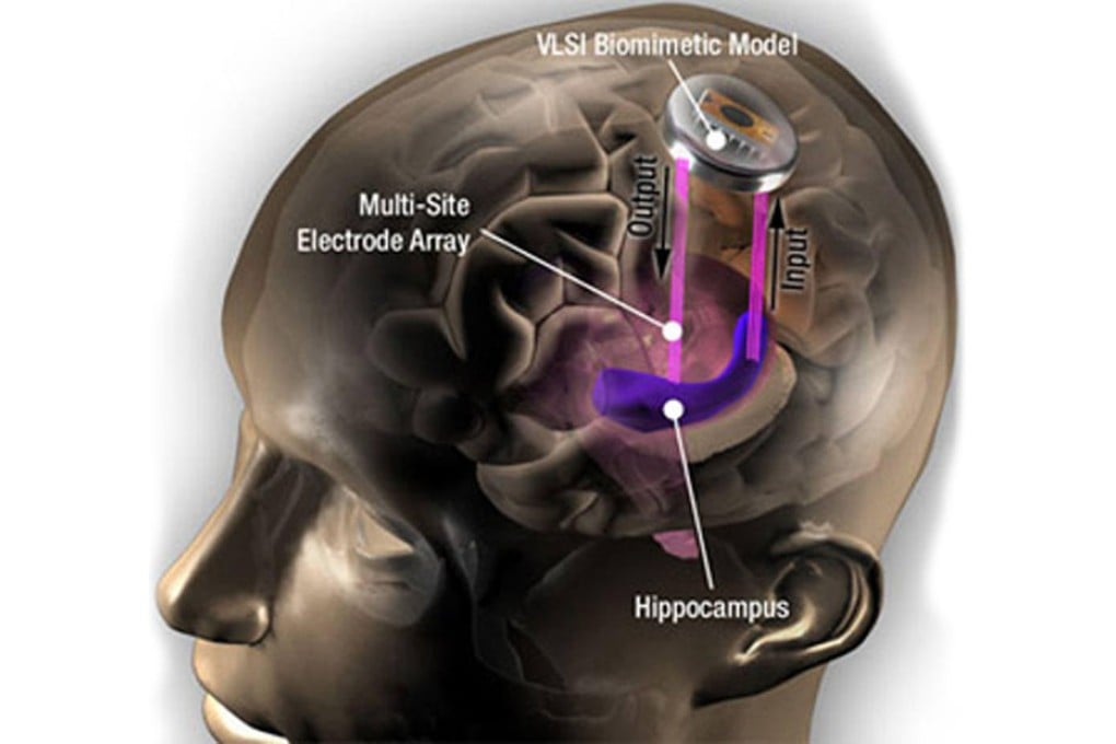 The brain implant.