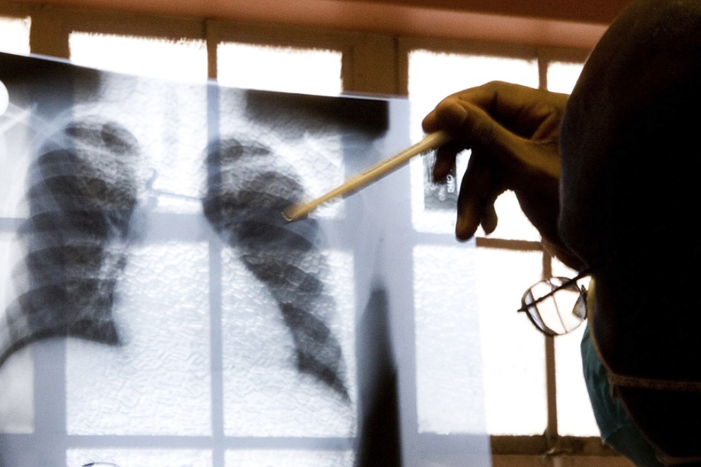 A doctor examines chest X-rays at a tuberculosis clinic in Gugulethu, Cape Town. Photo: AP