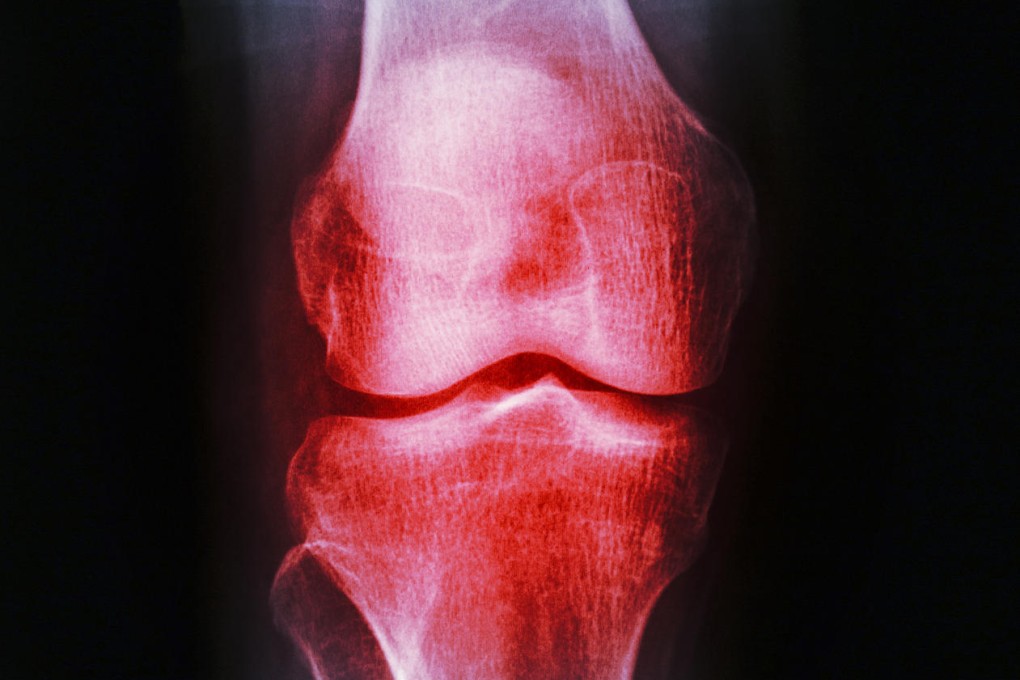 An X-ray of a knee joint from a patient suffering from osteoarthritis. Photo: Shutterstock