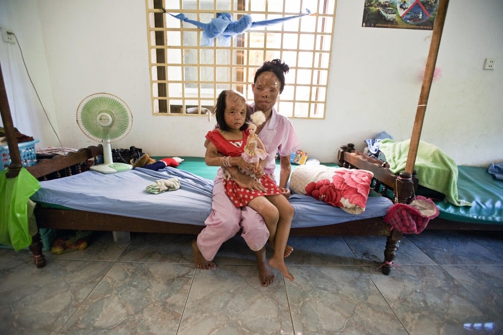 Chheav Chenda and her daughter, Malita, were attacked with acid in 2008 in Phnom Penh. They now live in a poor shantytown, shunned by most of Cambodian society. Photos: AP; Corbis; Tibor Krausz