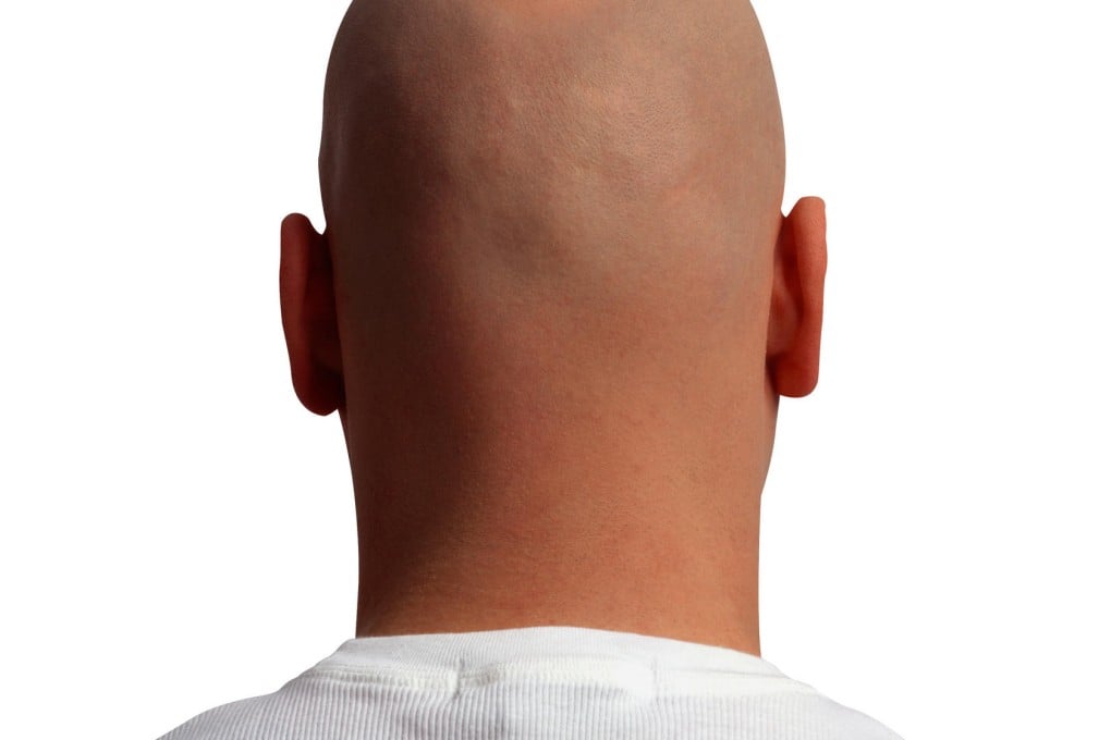 Bone marrow drug breakthrough for alopecia sufferers