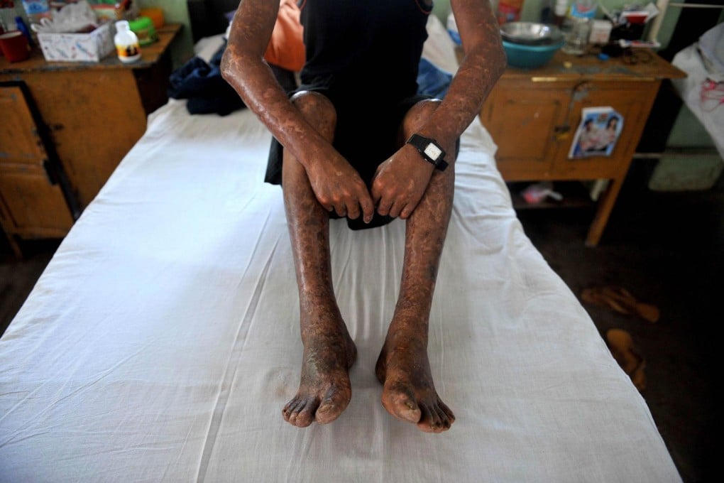 A leprosy patient sits on his bed in a hospital in Mawlamyaing. Photo: AFP