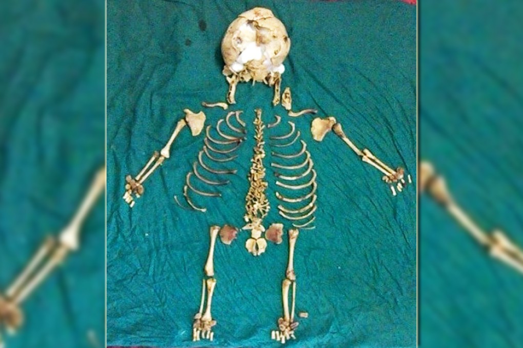 The fetus' skeleton after it was removed. Photo: AFP