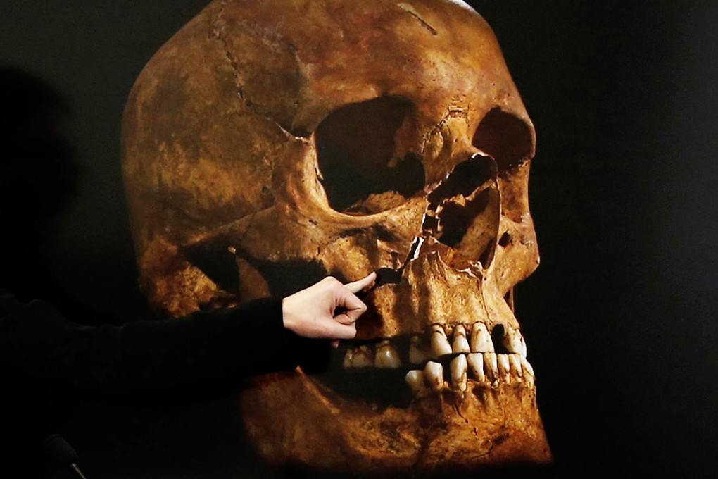 Researcher points to damage on the Richard III's skull. Evidence shows he was not wearing a helmet when he died. Photo: Reuters