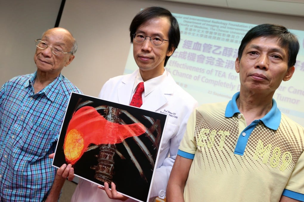 Dr Simon Yu (centre) with liver cancer survivors Mr Soong (left) and Mr Kum, who underwent the new treatment. Photo: David Wong