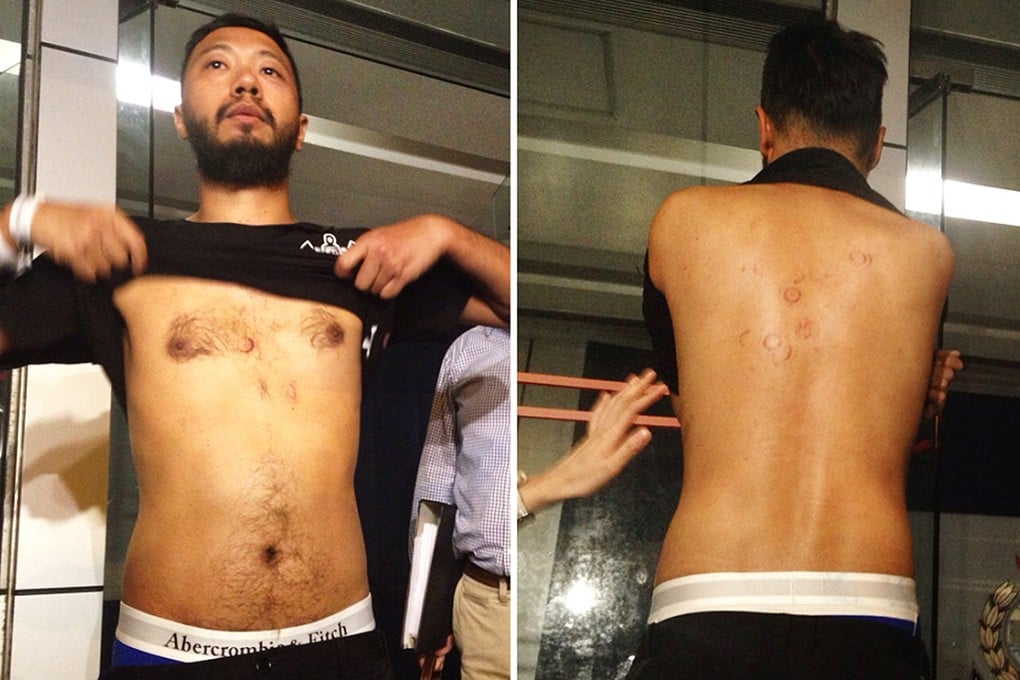 Ken Tsang shows some of the injuries to his body. Photo: Jennifer Ngo