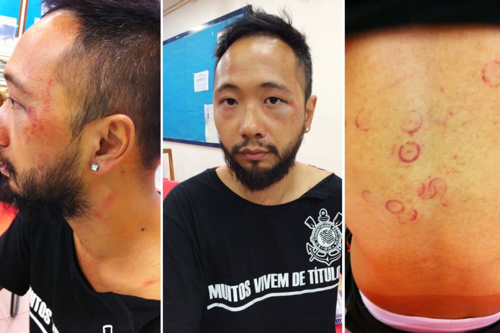 Ken Tsang appeared to have sustained severe bruising following an alleged beating caught on camera and aired on television. Photos: Civic Party