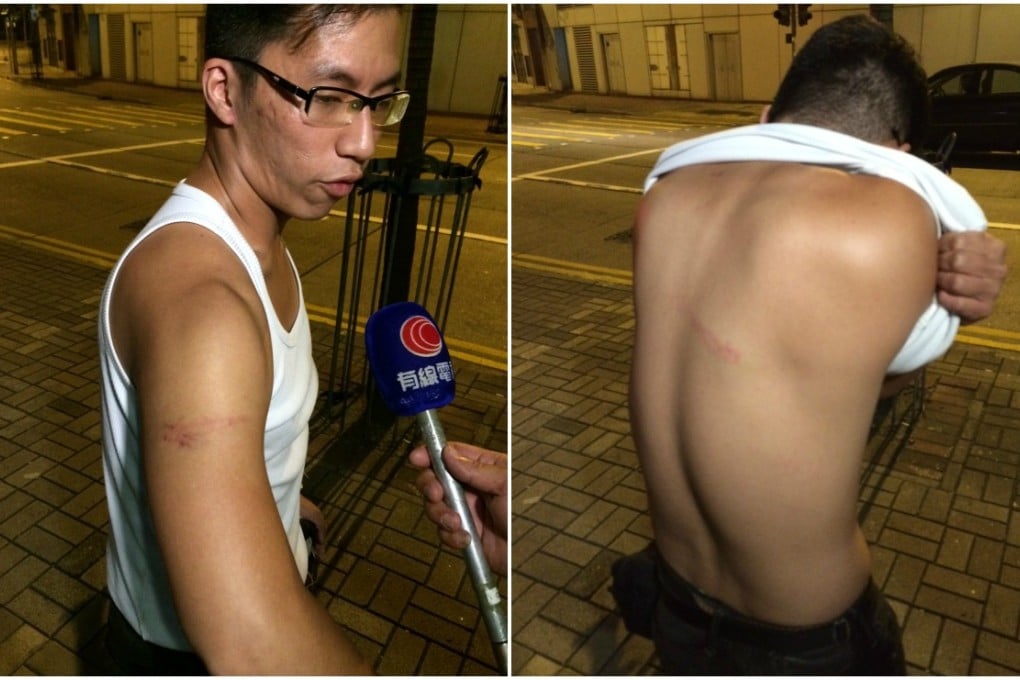 Social worker Isaac Tong shows bruises he says were inflicted by police on Wednesday morning. Photo: Samuel Chan