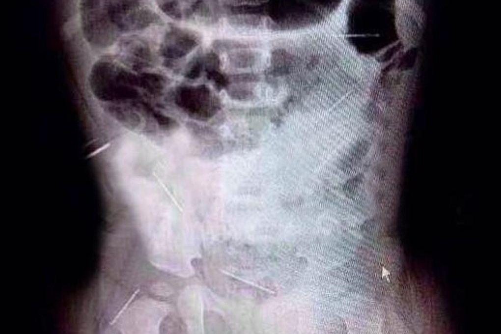 A X-ray show some of the needles in the baby girl's body.