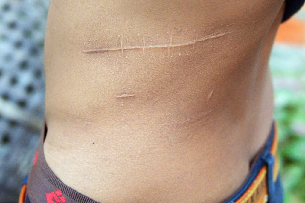 Chhay, 18, sold his kidney for $3,000 in an illicit deal. Photo: AFP