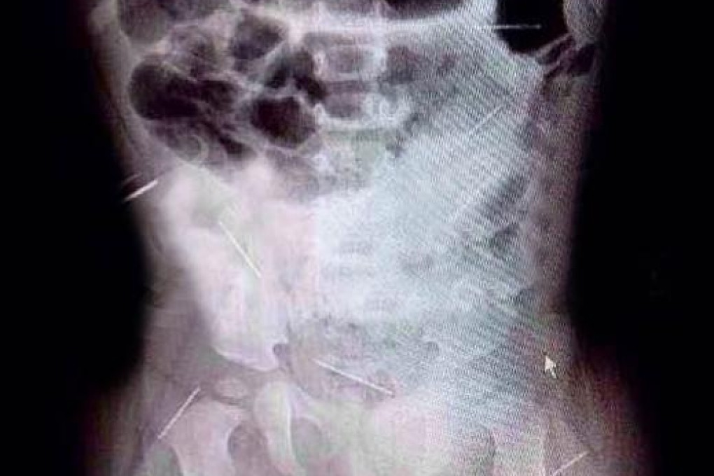 An X-ray of the girl's body showed needles had been pushed into her