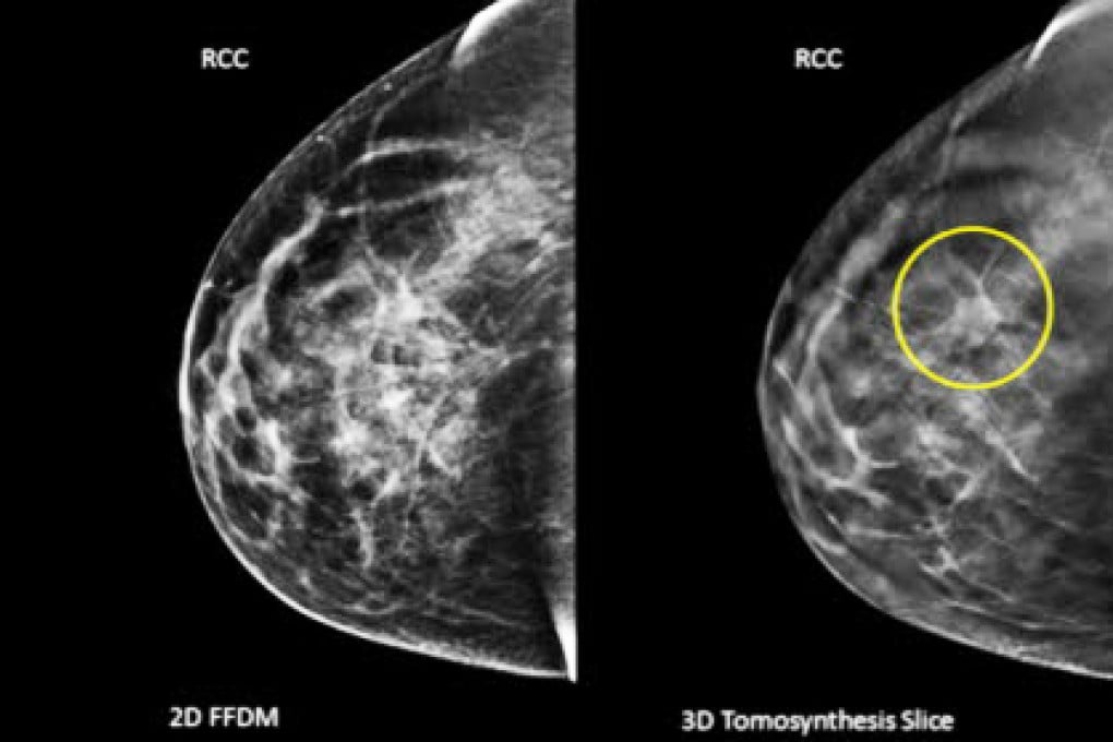 Breast cancer had the highest survival rate in China at 73 per cent. Photo: AP