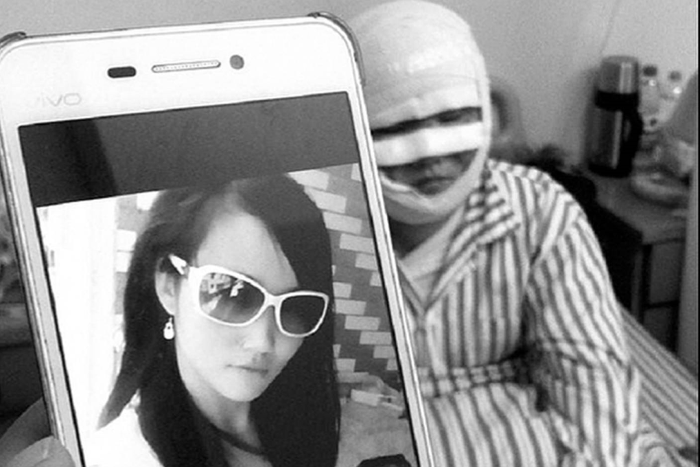 A young woman in Zhejiang, above, picture before and after she was severely injured when an electric hot-water bottle exploded as she unplugged it from the wall socket. FULL STORY BELOW. Photo: SCMP Pictures