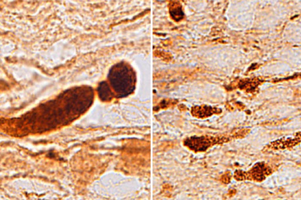 A honeycomb pattern of broken connections, primarily in the frontal lobes, are signs of a brain injury. Photos: The Washington Post
