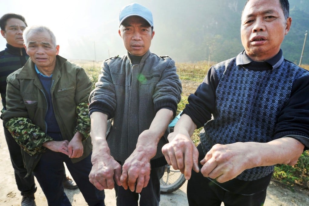 Villagers of Sanhe village in Guangxi show swollen hands suspected of being caused by cadmium and other pollutants. Photo: Kyodo