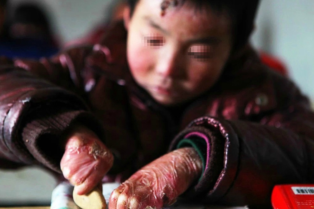 Song Liucheng regularly attends school, despite his painful condition. Photo: CCTV News