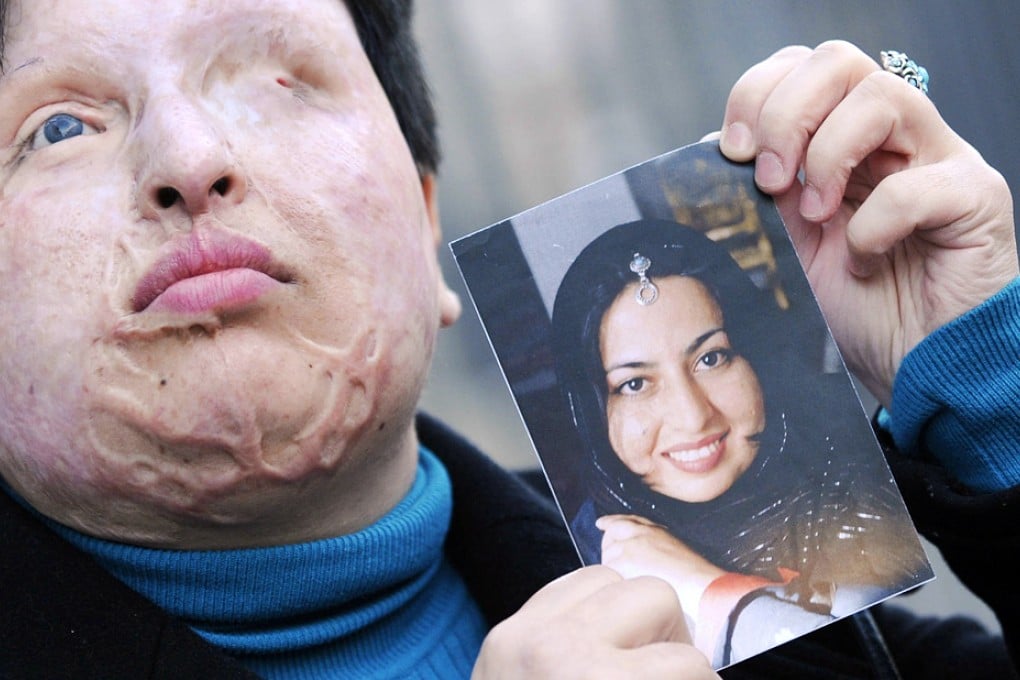 Acid victim Ameneh Bahrami received praise in 2011 for pardoning her attacker. Photo: AFP
