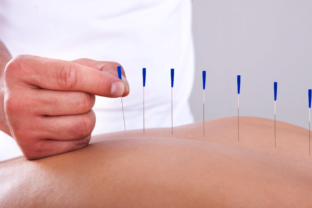 The woman died after receiving acupuncture treatment. Photo: Shutterstock