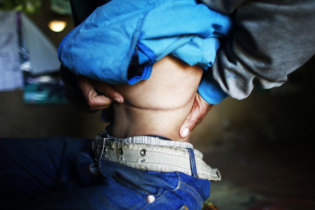 A man displays the surgery scars after he sold one of his kidneys to organ traffickers, in Hokshe, a village in Nepal. Photo: AP