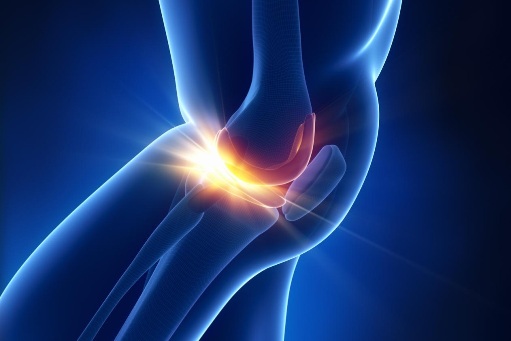 Osteoarthritis results in a breakdown of cartilage in joints.