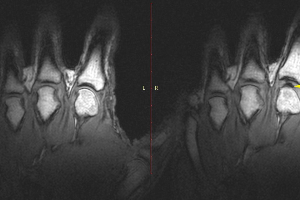 An MRI reveals a gas-filled cavity forming inside the joint when the knuckle is cracked. Scientists say this is what causes the popping sound.