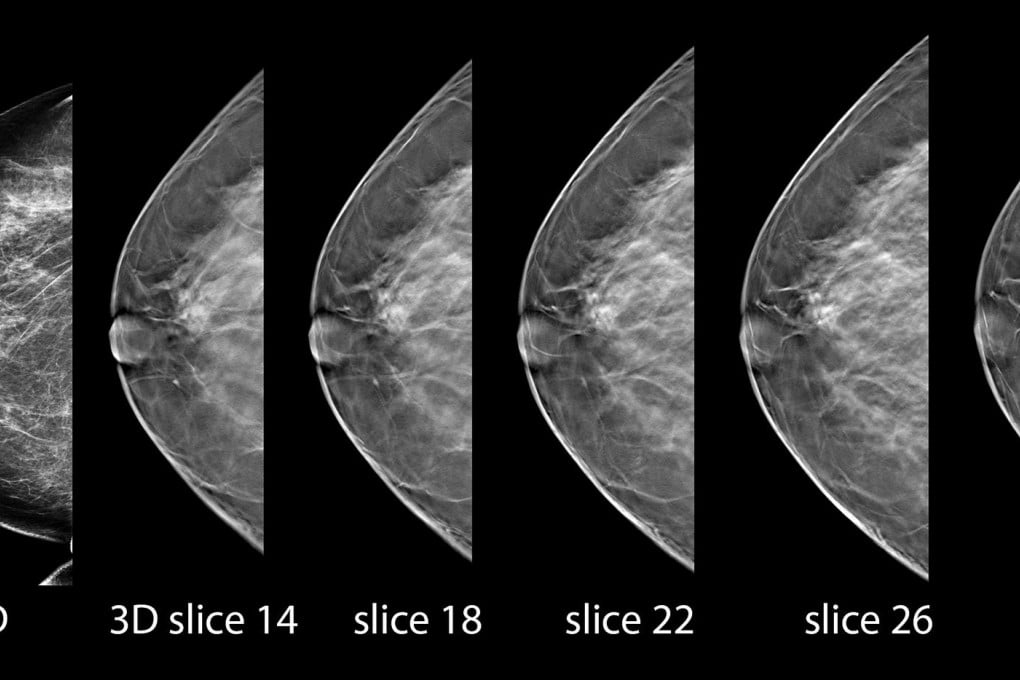 X-ray images taken from a 3-D mammography procedure.