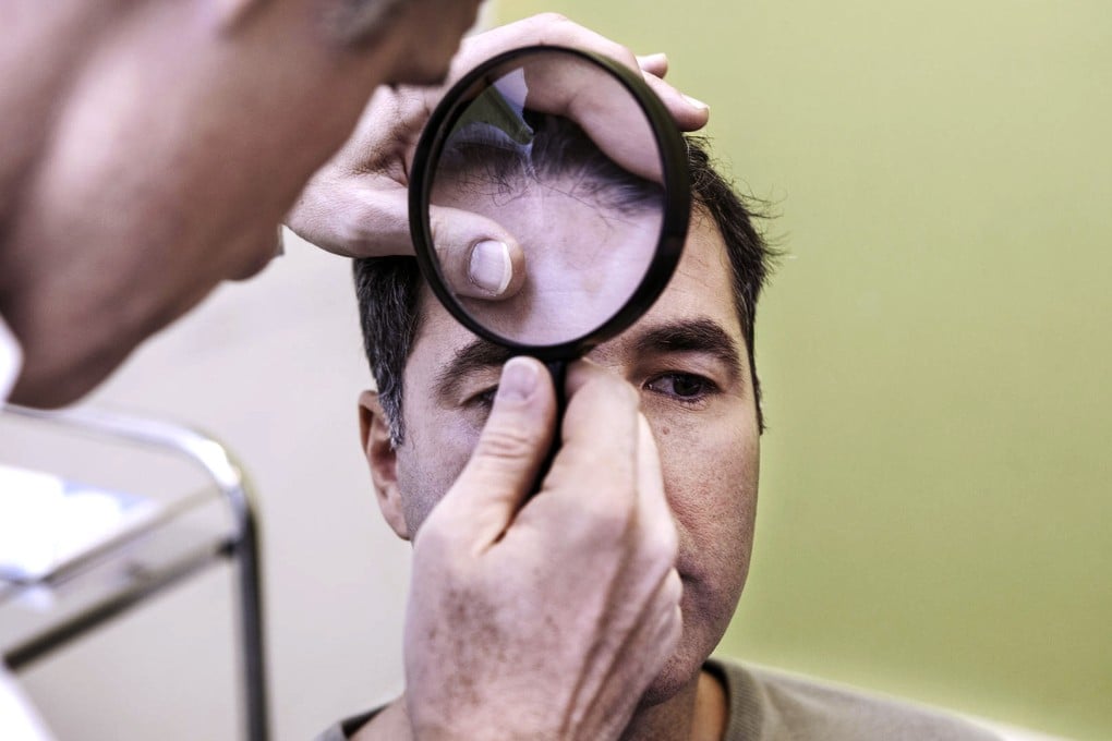 The good news is that hair loss as a result of a bad diet or deficiency will correct itself once the underlying cause is put right.
