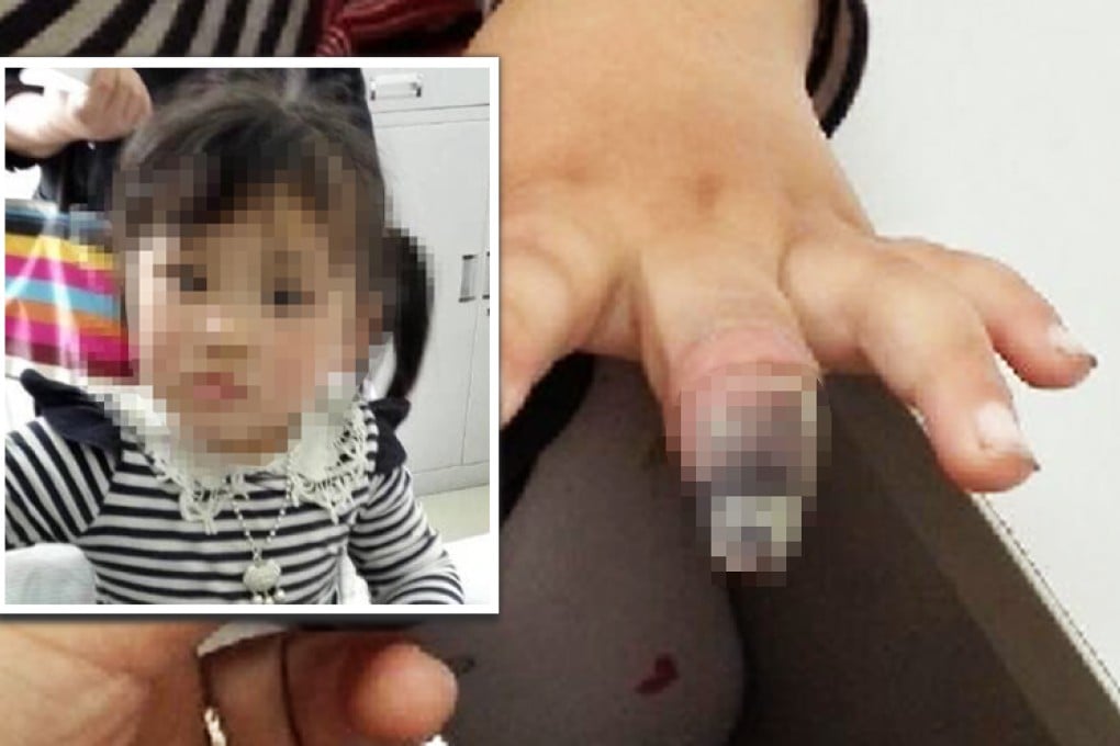 Doctors in Suzhou said poor blood circulation, caused by the tight binding around the tip of her finger, caused it to turn black. Photo: weibo