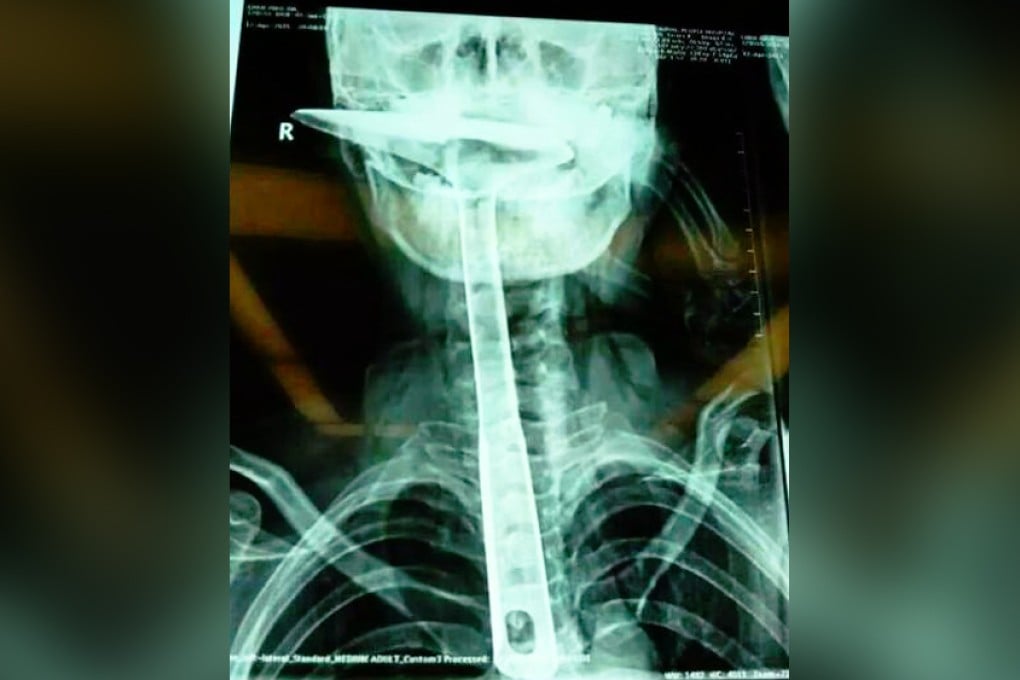 An X-ray of the spatula in the woman's throat. She is recovering in hospital. Photo: SCMP Pictures