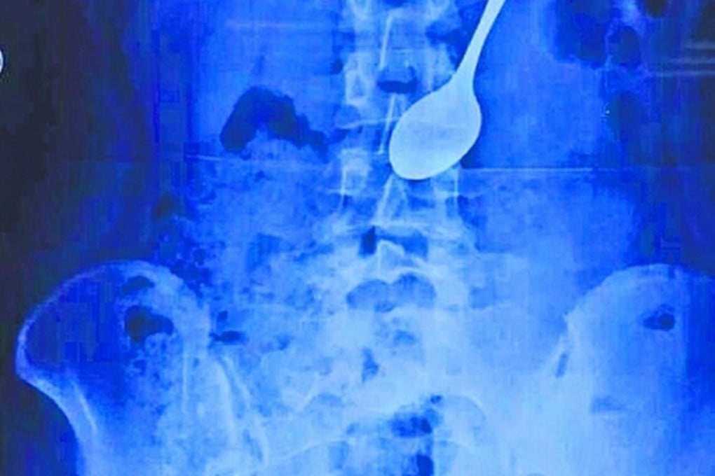 An X-ray shows the swallowed spoon in the student's stomach. Photo: SCMP Pictures