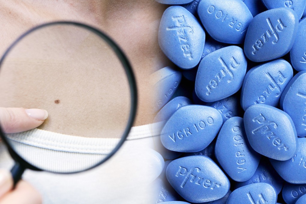 Using Swedish medical records spanning 2006 to 2012, researchers found about 4,000 cases of melanoma. Of those patients, 11 per cent had filled at least one prescription for a PDE5 inhibitor to treat erectile dysfunction.
