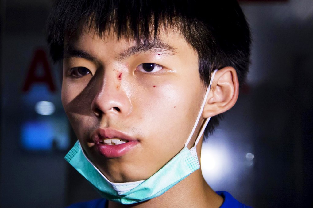 Student leader Joshua Wong shows his injuries after receiving treatment at Kwong Wah Hospital. A man attacked him in Tai Kok Tsui shortly after midnight. Photo: Reuters