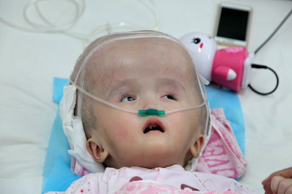 Three-year-old Hanhan suffered from hydrocephalus, causing her brain and skull to swell. Doctors managed to successfully transplant her skull with a 3d-printed replacement. Photo: Reuters