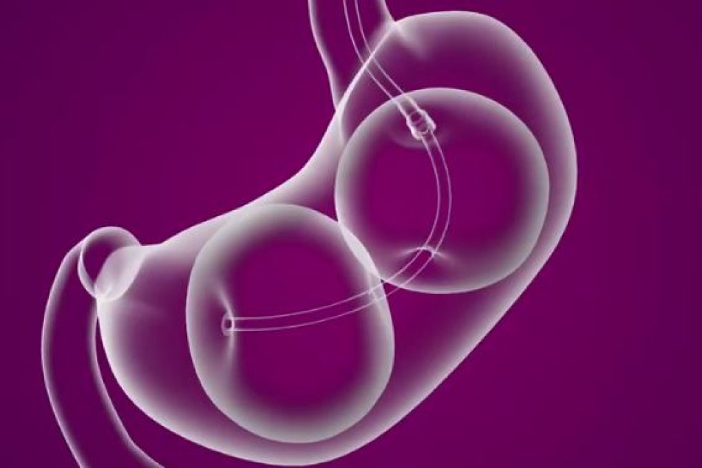 The procedure to implant and inflate the balloon inside the stomach takes only 30 minutes, according to its maker. Photo: Reshape Medical