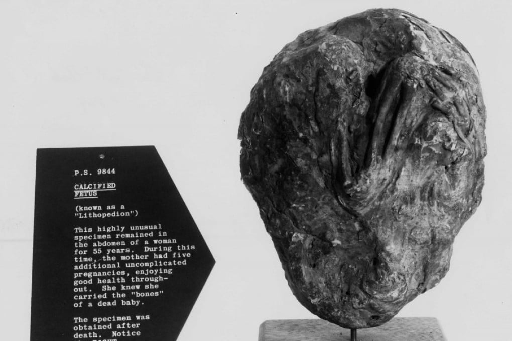 This lithopedion - not the one found in a woman in Chile this year - shows the right arm and hand of the unborn child. Photo: Wikipedia