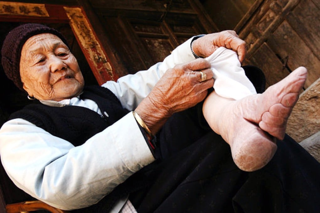 Zhou Guizhen who is 86 years old, shows one of her bound feet where the bones in the four small toes were broken and forced underneath the foot over a period of time in China's southern Yunnan Province. Photo: AFP