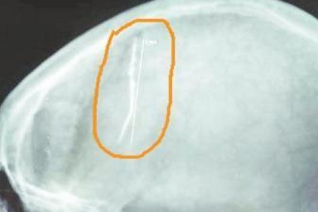 The needle is thought to have been accidentally inserted in Wang Xiaohong's head when she was a child. Photo: SCMP Pictures